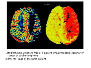 Left: Perfusion-weighted MRI of a patient who presented 1 hour after
onset of stroke symptoms
Right: MTT map of the same patient
 