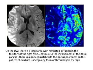 On the DWI there is a large area with restricted diffusion in the
territory of the right MCA , notice also the involvement of the basal
ganglia , there is a perfect match with the perfusion images so this
patient should not undergo any form of thrombolytic therapy
 