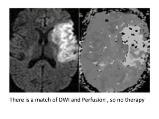 There is a match of DWI and Perfusion , so no therapy
 