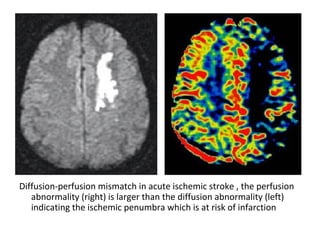 Diffusion-perfusion mismatch in acute ischemic stroke , the perfusion
abnormality (right) is larger than the diffusion abnormality (left)
indicating the ischemic penumbra which is at risk of infarction
 