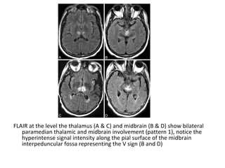 FLAIR at the level the thalamus (A & C) and midbrain (B & D) show bilateral
paramedian thalamic and midbrain involvement (pattern 1), notice the
hyperintense signal intensity along the pial surface of the midbrain
interpeduncular fossa representing the V sign (B and D)
 