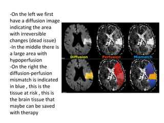 -On the left we first
have a diffusion image
indicating the area
with irreversible
changes (dead issue)
-In the middle there is
a large area with
hypoperfusion
-On the right the
diffusion-perfusion
mismatch is indicated
in blue , this is the
tissue at risk , this is
the brain tissue that
maybe can be saved
with therapy
 