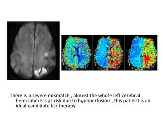 There is a severe mismatch , almost the whole left cerebral
hemisphere is at risk due to hypoperfusion , this patient is an
ideal candidate for therapy
 