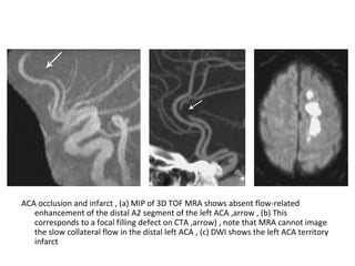 ACA occlusion and infarct , (a) MIP of 3D TOF MRA shows absent flow-related
enhancement of the distal A2 segment of the left ACA ,arrow , (b) This
corresponds to a focal filling defect on CTA ,arrow) , note that MRA cannot image
the slow collateral flow in the distal left ACA , (c) DWI shows the left ACA territory
infarct
 