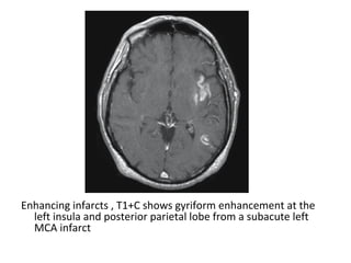 Enhancing infarcts , T1+C shows gyriform enhancement at the
left insula and posterior parietal lobe from a subacute left
MCA infarct
 