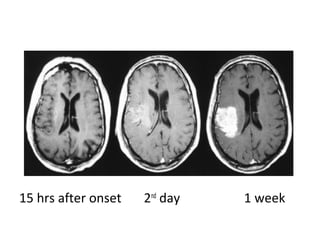 15 hrs after onset 2nd
day 1 week
 