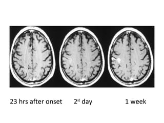 23 hrs after onset 2nd
day 1 week
 