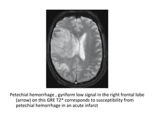 Petechial hemorrhage , gyriform low signal in the right frontal lobe
(arrow) on this GRE T2* corresponds to susceptibility from
petechial hemorrhage in an acute infarct
 