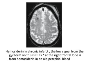 Hemosiderin in chronic infarct , the low signal from the
gyriform on this GRE T2* at the right frontal lobe is
from hemosiderin in an old petechial bleed
 