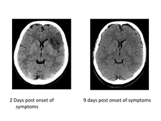 2 Days post onset of
symptoms
9 days post onset of symptoms
 