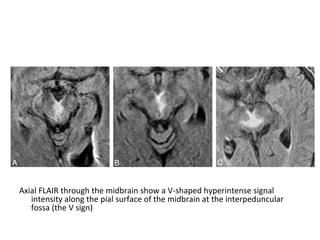 Axial FLAIR through the midbrain show a V-shaped hyperintense signal
intensity along the pial surface of the midbrain at the interpeduncular
fossa (the V sign)
 