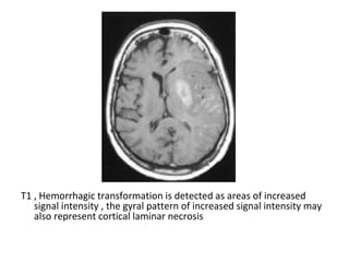 T1 , Hemorrhagic transformation is detected as areas of increased
signal intensity , the gyral pattern of increased signal intensity may
also represent cortical laminar necrosis
 