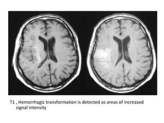 T1 , Hemorrhagic transformation is detected as areas of increased
signal intensity
 