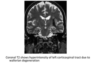 Coronal T2 shows hyperintensity of left corticospinal tract due to
wallerian degeneration
 