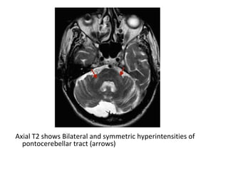 Axial T2 shows Bilateral and symmetric hyperintensities of
pontocerebellar tract (arrows)
 