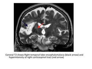 Coronal T2 shows Right temporal lobe encephalomalacia (black arrow) and
hyperintensity of right corticospinal tract (red arrow)
 