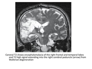 Coronal T2 shows encephalomalacia of the right frontal and temporal lobes
and T2 high signal extending into the right cerebral peduncle (arrow) from
Wallerian degeneration
 