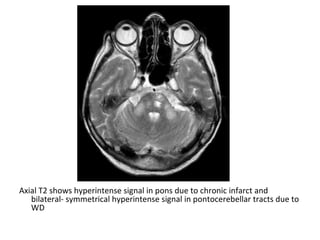 Axial T2 shows hyperintense signal in pons due to chronic infarct and
bilateral- symmetrical hyperintense signal in pontocerebellar tracts due to
WD
 