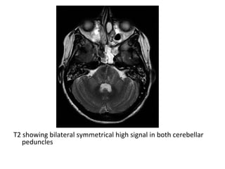 T2 showing bilateral symmetrical high signal in both cerebellar
peduncles
 