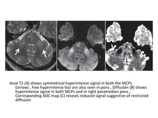 Axial T2 (A) shows symmetrical hyperintense signal in both the MCPs
(arrow) , Few hyperintense foci are also seen in pons , Diffusion (B) shows
hyperintense signal in both MCPs and in right paramedian pons ,
Corresponding ADC map (C) reveals reduced signal suggestive of restricted
diffusion
 