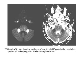 DWI and ADC map showing evidence of restricted diffusion in the cerebellar
peduncles in keeping with Wallerian degeneration
 