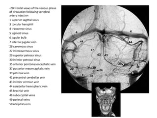 -2D frontal views of the venous phase
of circulation following vertebral
artery injection
1 superior sagittal sinus
3 torcular herophili
4 transverse sinus
5 sigmoid sinus
6 jugular bulb
7 internal jugular vein
26 cavernous sinus
27 intercavernous sinus
29 superior petrosal sinus
30 inferior petrosal sinus
35 anterior pontomesencephalic vein
37 posterior mesencephalic vein
39 petrosal vein
41 precentral cerebellar vein
43 inferior vermian vein
44 cerebellar hemispheric vein
45 brachial vein
46 suboccipital veins
49 parietal veins
50 occipital veins
 