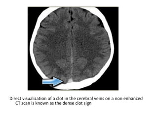 Direct visualization of a clot in the cerebral veins on a non enhanced
CT scan is known as the dense clot sign
 
