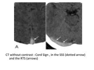 CT without contrast : Cord Sign , in the SSS (dotted arrow)
and the RTS (arrows)
 