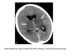 Attenuated vein sign in both ICVs (thin arrows), in the SS (crossed arrow)
 