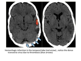 Hemorrhagic infarction in the temporal lobe (red arrow) , notice the dense
transverse sinus due to thrombosis (blue arrows)
 