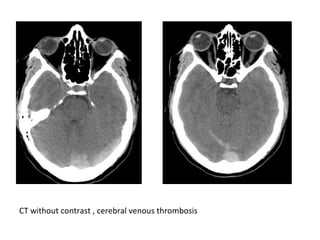 CT without contrast , cerebral venous thrombosis
 