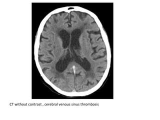 CT without contrast , cerebral venous sinus thrombosis
 
