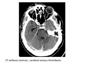 CT without contrast , cerebral venous thrombosis
 