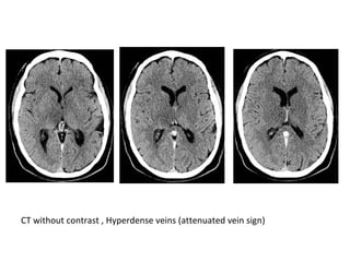 CT without contrast , Hyperdense veins (attenuated vein sign)
 