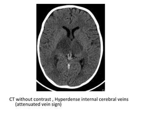 CT without contrast , Hyperdense internal cerebral veins
(attenuated vein sign)
 