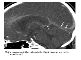 CT+C shows contrast-filling defects in the ICVs (thin arrow) and the SS
(crossed arrows)
 
