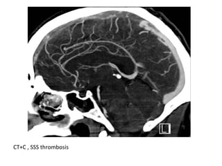 CT+C , SSS thrombosis
 