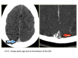 CT+C : Empty delta sign due to thrombosis of the SSS
 