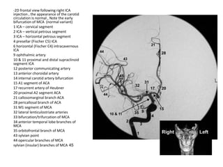 -2D frontal view following right ICA
injection , the appearance of the carotid
circulation is normal , Note the early
bifurcation of MCA (normal variant)
1 ICA – cervical segment
2 ICA – vertical petrous segment
3 ICA – horizontal petrous segment
4 presellar (Fischer C5) ICA
6 horizontal (Fischer C4) intracavernous
ICA
9 ophthalmic artery
10 & 11 proximal and distal supraclinoid
segment ICA
12 posterior communicating artery
13 anterior choroidal artery
14 internal carotid artery bifurcation
15 A1 segment of ACA
17 recurrent artery of Heubner
20 proximal A2 segment ACA
21 callosomarginal branch ACA
28 pericallosal branch of ACA
31 M1 segment of MCA
32 lateral lenticulostriate arteries
33 bifurcation/trifurcation of MCA
34 anterior temporal lobe branches of
MCA
35 orbitofrontal branch of MCA
43 sylvian point
44 opercular branches of MCA
45sylvian (insular) branches of MCA
 