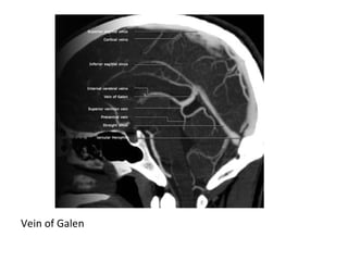 Vein of Galen
 