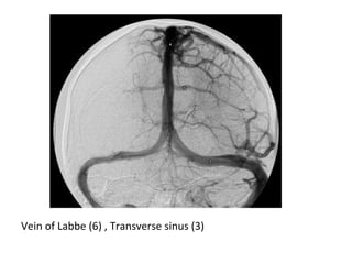 Vein of Labbe (6) , Transverse sinus (3)
 