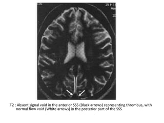 T2 : Absent signal void in the anterior SSS (Black arrows) representing thrombus, with
normal flow void (White arrows) in the posterior part of the SSS
 