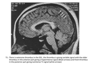 T1 : There is extensive thrombus in the SSS , the thrombus is giving variable signal with the older
thrombus in the anterior part giving a hyperintense signal (Black arrows) and fresh thrombus
in the posterior part giving isointense T1 signal (white arrows)
 