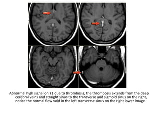 Abnormal high signal on T1 due to thrombosis, the thrombosis extends from the deep
cerebral veins and straight sinus to the transverse and sigmoid sinus on the right,
notice the normal flow void in the left transverse sinus on the right lower image
 