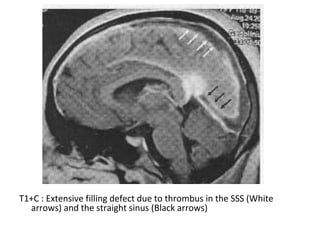 T1+C : Extensive filling defect due to thrombus in the SSS (White
arrows) and the straight sinus (Black arrows)
 