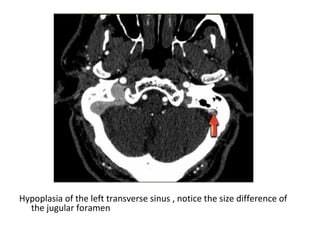 Hypoplasia of the left transverse sinus , notice the size difference of
the jugular foramen
 