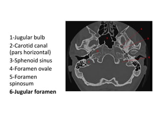 1-Jugular bulb
2-Carotid canal
(pars horizontal)
3-Sphenoid sinus
4-Foramen ovale
5-Foramen
spinosum
6-Jugular foramen
 