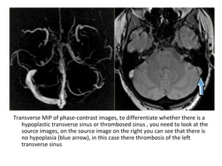 Transverse MIP of phase-contrast images, to differentiate whether there is a
hypoplastic transverse sinus or thrombosed sinus , you need to look at the
source images, on the source image on the right you can see that there is
no hypoplasia (blue arrow), in this case there thrombosis of the left
transverse sinus
 