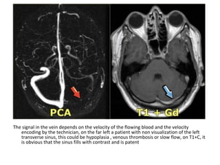 The signal in the vein depends on the velocity of the flowing blood and the velocity
encoding by the technician, on the far left a patient with non visualization of the left
transverse sinus, this could be hypoplasia , venous thrombosis or slow flow, on T1+C, it
is obvious that the sinus fills with contrast and is patent
 