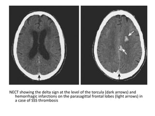 NECT showing the delta sign at the level of the torcula (dark arrows) and
hemorrhagic infarctions on the parasagittal frontal lobes (light arrows) in
a case of SSS thrombosis
 